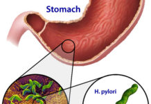 Chẩn đoán và điều trị bệnh chậm tiêu chức năng