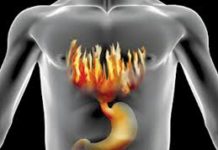 Nguyên nhân, triệu chứng bệnh viêm thực quản