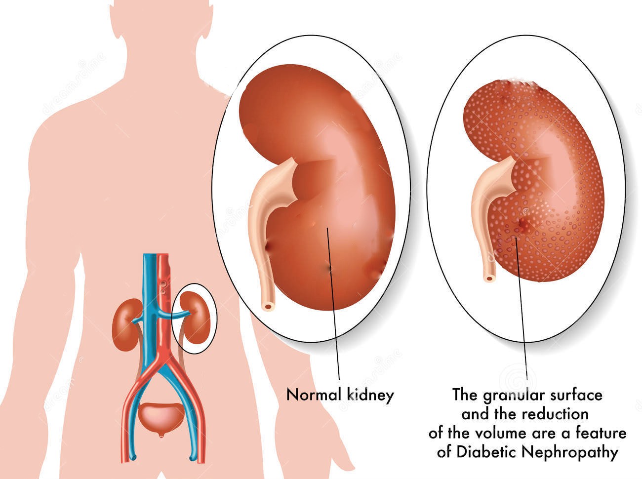 What are the clinical and biochemical characteristics of hội chứng thận hư (renal insufficiency syndrome)?