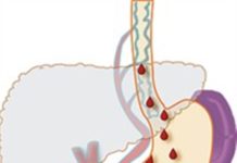 Điều trị xuất huyết tiêu hóa do dãn vỡ tĩnh mạch thực quản ở bệnh nhân xơ gan