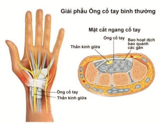 Những điều cần biết về bệnh hội chứng ống cổ tay - FAMILY HOSPITAL