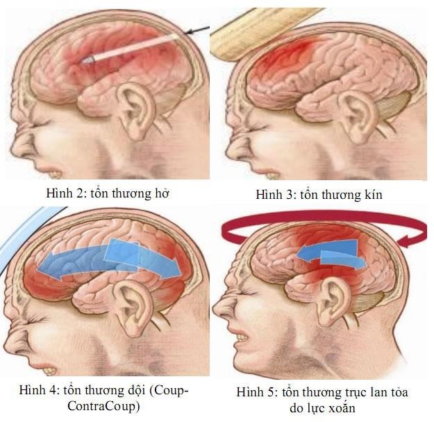 Chấn Thương Sọ Não Chảy Máu Tai: Nguyên Nhân, Triệu Chứng Và Cách Điều Trị