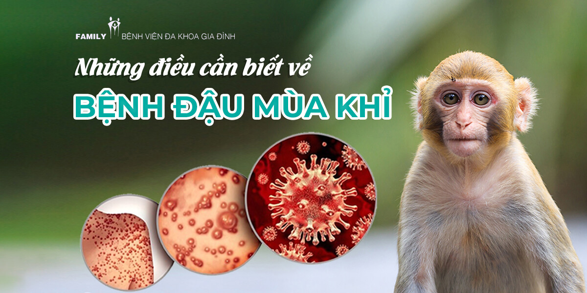 Bệnh đậu mùa khỉ ảnh hưởng tới ai và có thể phòng ngừa được không?
