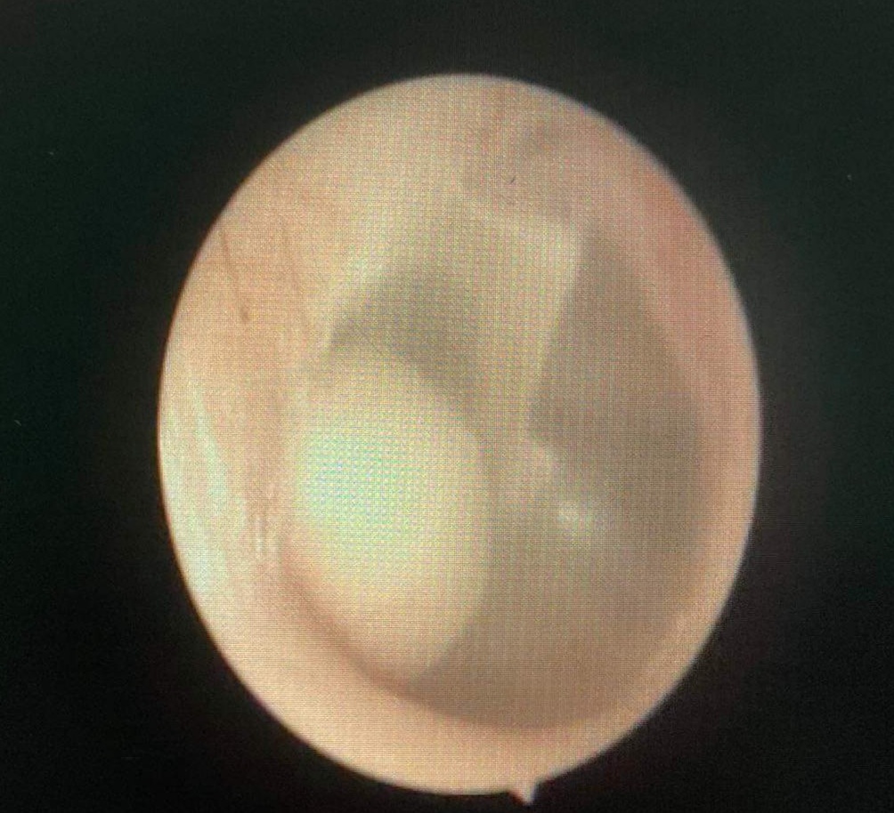 KHỐI CHOLESTEATOMA CHỤP CT (1)
